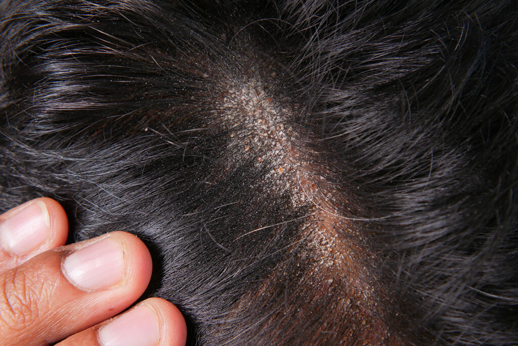 pellicules et résidus de cire